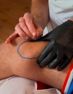 Dry Needling des Points Triggers Myofasciaux (PTrM).